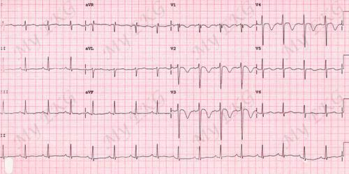 Eletrocardiograma da síndrome de Wellens tipo B