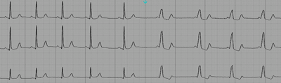 Different degree of pre-excitation in Wolff-Parkinson-White Syndrome