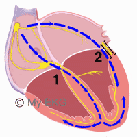 Anatomie du syndrome de Wolff-Parkinson-White