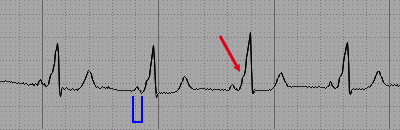 Eletrocardiograma da Síndrome de Wolff-Parkinson-White