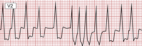 Fibrilación Auricular con Síndrome de Wolff-Parkinson- White